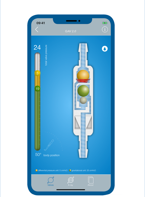 Screenshot der Hydrocephalus App MIETHKE App – ein Blick ins Innere der MIETHKE Shunts zeigt den Fluss durch das Ventil für ein besseres Verständnis der Funktionsweise.